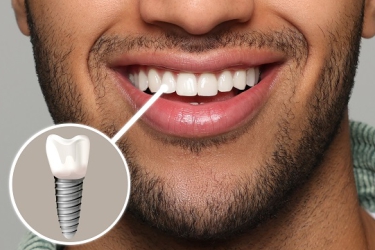 Dental Implants Procedure in Meerut, Best Dental Clinic for Dental Implants, Best Dentist for Dental Implants in Meerut, Cost of Dental Implants in Meerut, Uttar Pradesh, Dr Shalabh Kumar, Dr Astha Verma, The Dental Doctors