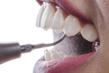 Scaling and Polishing Treatment in Meerut, Best Dental Clinic in Ganganagar for Scaling, Cost of Teeth Scaling and Polishing in Meerut, Dr Astha Verma Best Dentist for Scaling and Polishing 